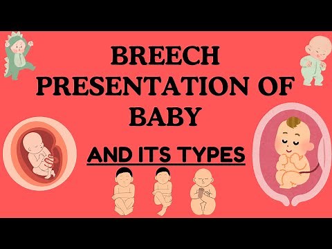 Breech Presentation of Baby: Understanding, Types, Risks, and Delivery Options
