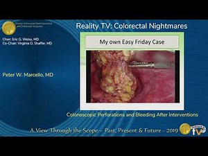 Colonoscopic Perforations and Bleeding After Interventions • Video • MEDtube.net