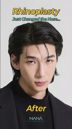 A New Nose Line, A New Vibe! #koreanplasticsurgery