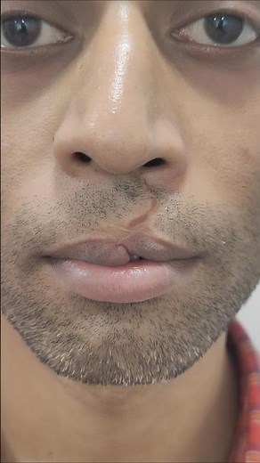 Lip Scar Removal Without General Anesthesia | Expert Scar Revision Surgery