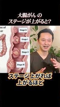 大腸がんのステージが上がるとどうなるのかを消化器内科医が解説！