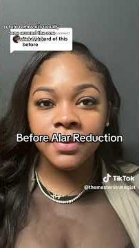 An alar base reduction is an in-office procedure where we change the size and shape of the nostrils