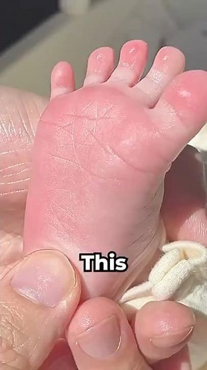BABINSKI Reflex Explained 👣