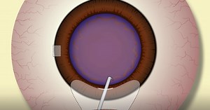 MSICS for the Phaco Surgeon - Eyetube
