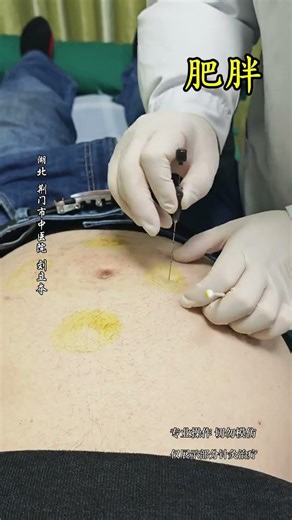 Revolutionary Acupoint Therapy for Weight Loss - TCM Secrets Revealed