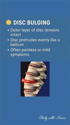 Difference between disc bulging and disc herniation | #discbulge #discherniation