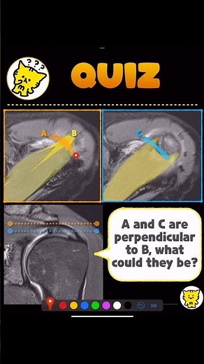 Rotator Cable vs. Coracoacromial Ligament on MRI