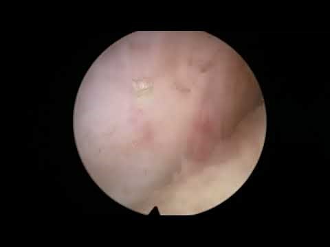 Real life ThuLEP case number 1