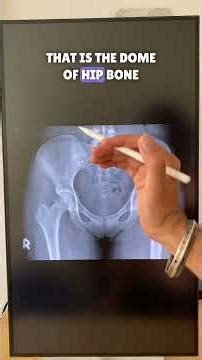 Reading Hip & Pelvis X-Rays Like a Pro! 🩻✅