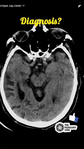 Diagnosis⬇️ #Neuroimaging #TheRadiologyLens#BrainCT #CTScan #CTBrain #BrainImaging #Radiology #MedicalImaging #CTHead #BrainScan #Radiologist #RadiologyLife #RadiologyReels #RadiologyEducation #CTandMRI #DiagnosticImaging #HeadCT #StrokeImaging #EmergencyRadiology #NeuroCT #RadiologyCases | The Radiology Lens