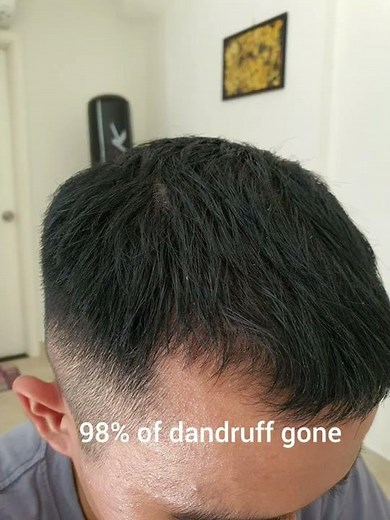 Day 30 Of Minoxidil Treatment | Without Finasteride