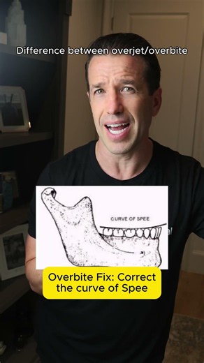 Correct overjet/overbife