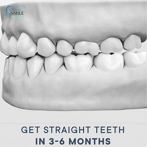 Transform your smile with ISMILE ALIGNERS. Achieve straight teeth in just 3 to 6 months and unlock the confidence of a radiant, beautiful smile. 퐅퐨퐫 퐌퐨퐫퐞 퐈퐧퐟퐨퐫퐦퐚퐭퐢퐨퐧 0335 2177797 03343000797 info@ismilealigners.co.uk www.ismilealigners.co.uk #ISmileAligners #StraightTeeth #SmileTransformation #OrthodonticSolution #ConfidentSmile #DentalBraces #BeautifulSmile | ISmile Aligners | Facebook