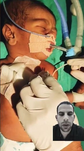 Needle decompression #baby