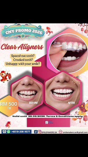 🧧✨ CNY Vibes, New Smile Energy! ✨🧧 This February, start the year right with Clear Aligners ✔ Clear ✔ Comfortable ✔ Confidence-boosting A brand new smile for a brand new year 🐉 📅 February promo only — limited slots! 📍 Come book with us now at Smile Makers Setia Alam #smilemakers #setiaalam #smiley #februarypromo #festivesmiles