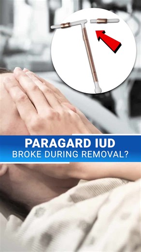 ⚖️ Thousands of women are taking action over Paragard breakage. If yours broke during removal, you may be owed compensation. ✅ Connect with a case specialist 📞 for a free, confidential review today. | Paragard Lawsuit Claim Help