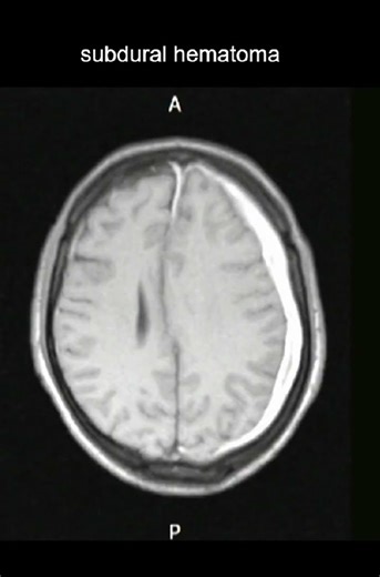 Brain MRI Full-Length Video (Brain Hemorrhages) – Official Teaser #MRI #Radiology #Shorts #teaser