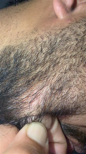 #ingrownhair #ingrownhairremoval #skincare #beard
