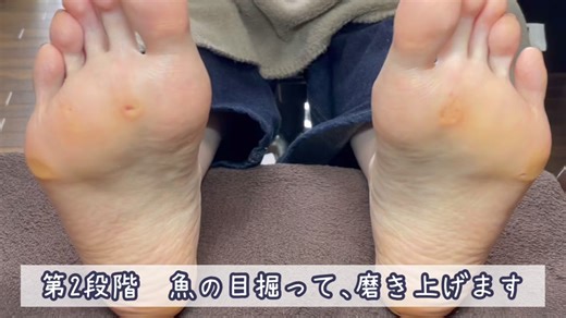 魚の目を自分で取り除く方法