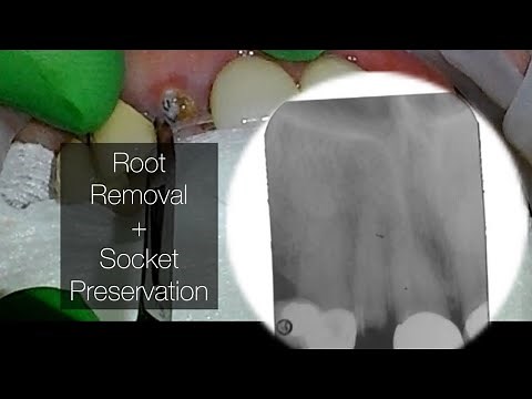 Root Removal with Socket Preservation with Collagen Membrane