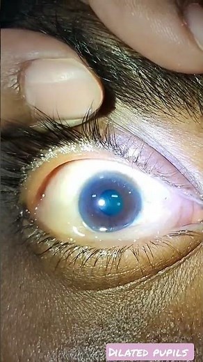 dilated pupils/gcs monitoring /brain death patient / neuromonitoring