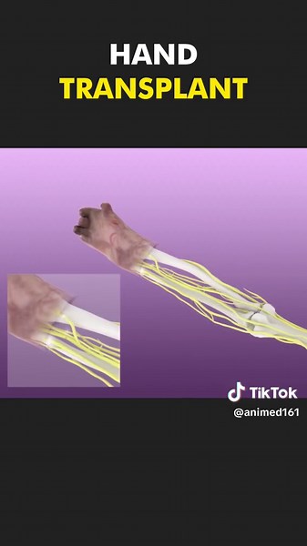 Hand Transplant Surgery 3D Animation