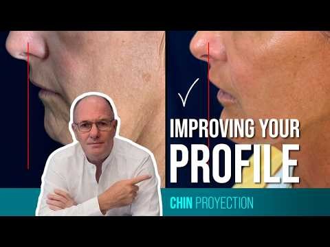 Chin projection using hyaluronic acid fillers - 26111