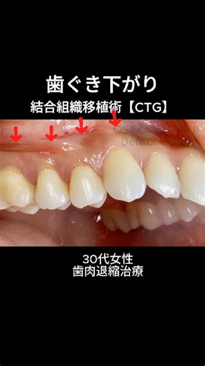 大阪つつい歯科 矯正歯科 理事長 筒井 純也 on Instagram: "30代女性、歯茎下がりが心配で来院されました。 当院で結合組織移植術【CTG】を行い、上下各1回の処置で自然な歯茎に改善しました。 結合組織移植【CTG】とは、歯肉の固く骨についている部分（結合組織）のみを移植する術式のことで、歯肉の色を元の部位の色のまま移植できることがメリットです。 歯茎が痩せたり下がったりすることは、見た目ももちろん、虫歯になりやすいなど、様々なリスクがあるため治療が必要なのですが、高度な診断力と技術が必要なため取り扱う歯科医師は極めて少ないのが実情です。 当院では歯肉退縮治療に豊富な症例があり、全国からこの治療を受けにいらっしゃいます。 A female in her 30s came to our clinic concerned about gum recession. We performed a connective tissue graft (CTG) procedure at our clinic, and in just one treatment, her gums we