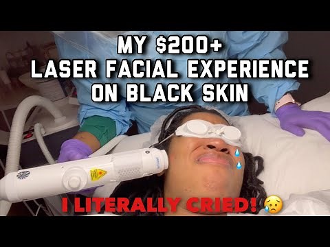 LASER ON BLACK SKIN- CHANGED MY LIFE| EXTRACTIONS|DARK MARKS |HYPERPIGMENTATION|ACNE |GOLDENCHILDCHI