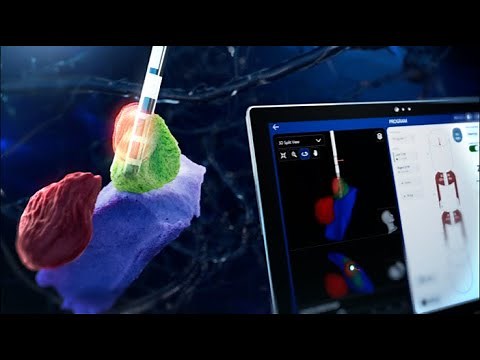 Boston Scientific’s next innovation in Image Guided Programming, Vercise™ Neural Navigator 5 (VN5)