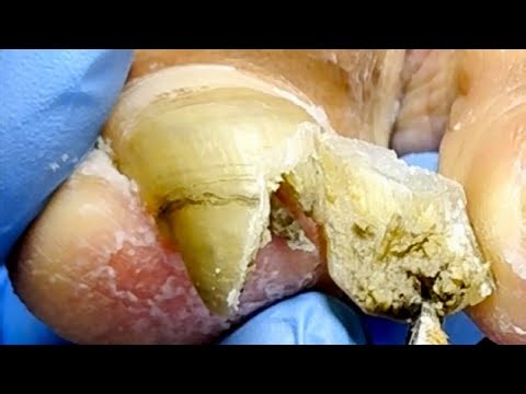 Very Long Toenails, Turned Green, Easy To Trim【Xue Yidao Pedicure】