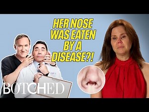 Lori’s Autoimmune Disease DESTROYED Her Nose and Lungs?! (Before & After) | Botched | E!