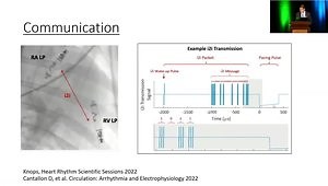 AVEIR DR - Dual Chamber Leadless Pacing