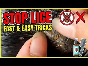 KILL LICE FAST! Best Home Remedies and Tricks That Work