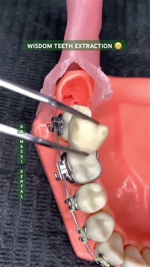 WISDOM TEETH EXTARCTION 🦷⚒️