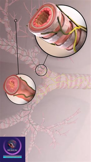 8.7K views · 56 reactions | Lung Denervation Procedure - COPD Disease Treatmen #doctor #documentaryphotography #DoctorWho #reel # shorts #DoctorWh#doctor | SMART Doctor | Facebook