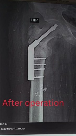 Intertrochanteric Fracture Fixed with DHS | Orthopedic Surgery Short