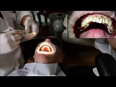 Replacement of PFM Anterior Crowns with Aesthetic Zirconia Chair side procedure