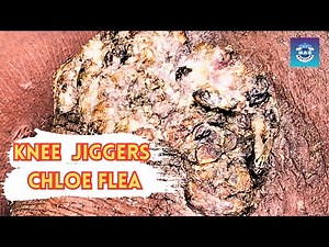 Most Jiggered Knee 🦵🏻- TREATMENT - long video-2 @HASMedicera