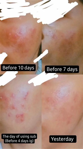 Clear skin subliminal results #clearskin #results #subliminalresults #subliminal #estellasubs