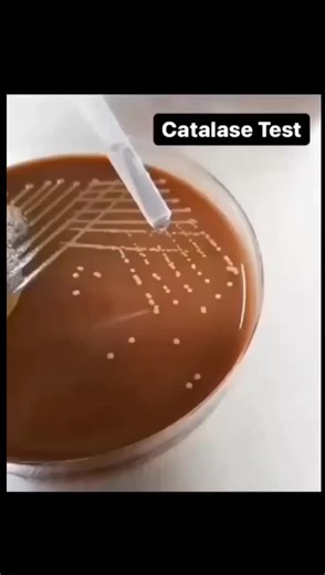 Patient's Catalase Test result is Positive. This indicates the presence of catalase enzyme, commonly found in many bacteria like Staph. #CatalaseTest #LabResults #Microbiology