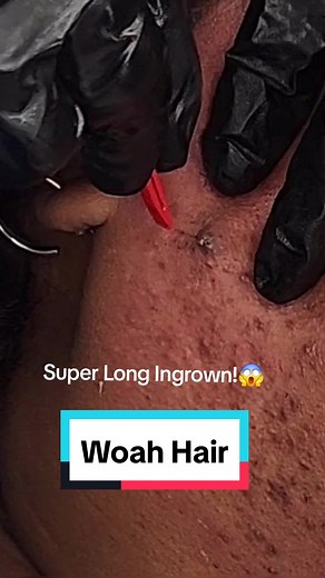 Amazing Ingrown Hair Extraction Techniques