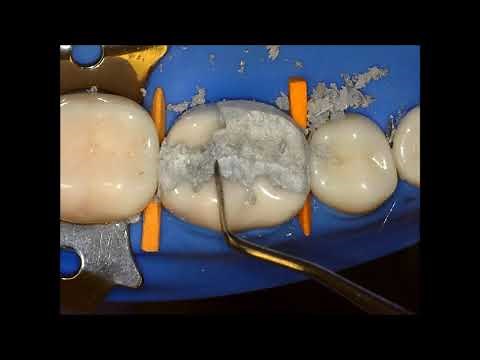 Complex Amalgam Restoration by Dr. Saulo Geraldeli