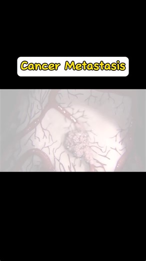 Cancer Metastasis #kanker #metastaticcancer #fyp #fypシ゚viral #oncologia #longervideos #tumor