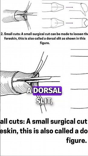 Exploring Alternatives to Circumcision #shorts