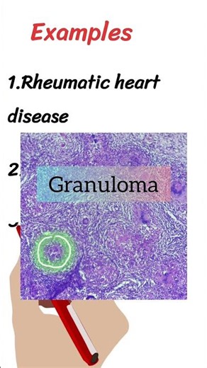 Shorts 09 | Dystrophic calcification