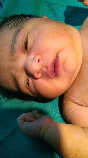 Medical Education Video: Neonatology: Nasal Flaring in Newborn