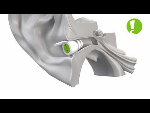 How to insert earplugs - AudioNova hearing protection