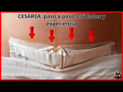 PARTO POR CESÁREA PASO A PASO l cuidados y experiencia #embarazo