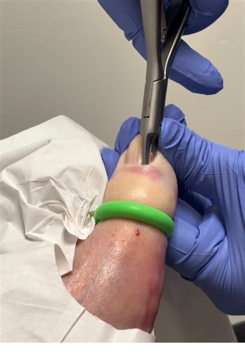 If you are struggling with ingrown toenails come schedule with Aloha Foot and Ankle!! #ingrown #nailremoval #podiatry #matrixectomy